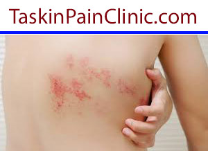 نورالژی و درد زونا