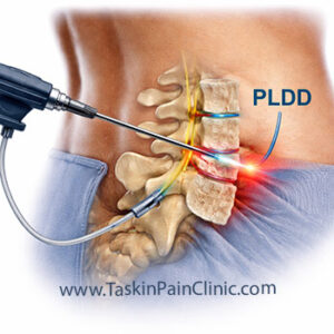عمل لیزر به روش PLDD: درمان کم‌تهاجمی دیسک فشرده کمر