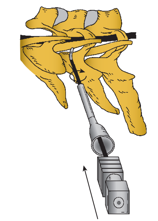 Cervical epidural(4)