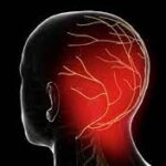 بلاک دائمی عصب اکسیپیتال سوم (Third occipital) با روش رادیوفرکوئنسی (Radiofrequency) تحت گاید فلوروسکوپی