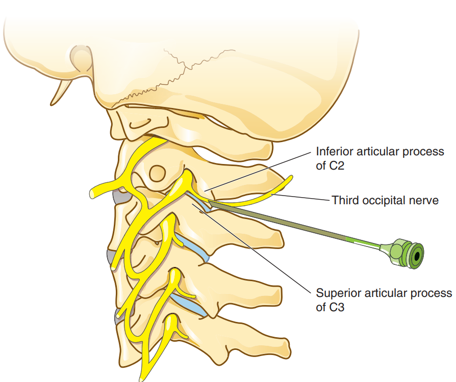 Third occipital(5)