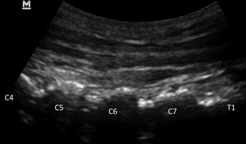 Translaminar(3)