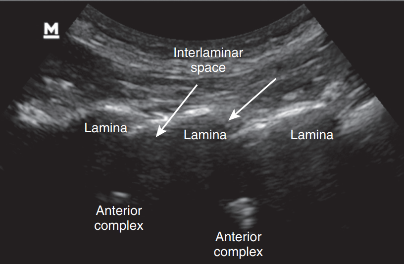 Translaminar(1)