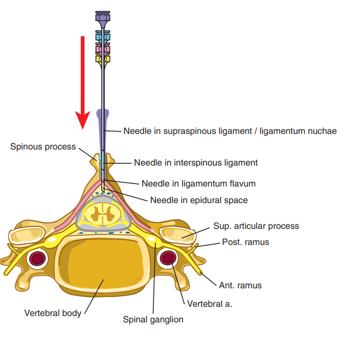 Translaminar(5)