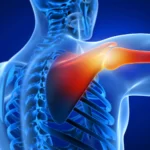 بلاک شبکه بازویی (Brachial plexus) با روش اینتراسکالن (Interscalene) تحت گاید CT Scan
