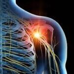 بلاک شبکه بازویی (Brachial plexus) با روش آگزیلاری (Axillary)