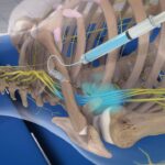 بلاک شبکه بازویی (Brachial plexus) با روش اینفراکلاویکولار (Infraclavicular) تحت گاید سونوگرافی