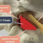 بلاک اپیدورال توراسیک (Thoracic، سینه ای) با روش ترانس فورامینال (Transforaminal) تحت گاید فلوروسکوپی
