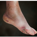 نوروپاتی دیابتی (Diabetic neuropathy)