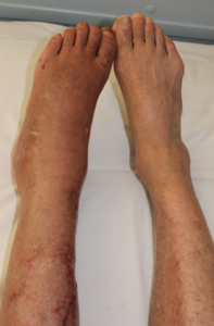 سندروم درد موضعی پیچیده (CRPS)