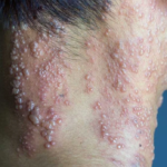 نورالژی بعد از ابتلا به هرپس (Postherpetic neuralgia)