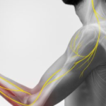 سندروم درد موضعی پیچیده (Complex regional pain syndrome)