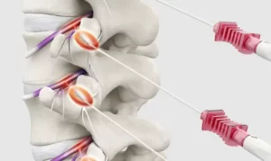 RF-lumbar