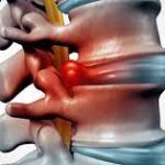 بیماری تخریب دیسک (Degenerative disc disease)