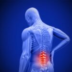 سندروم فاست کمری – lumbar facet syndrome
