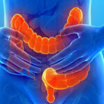 سندروم روده تحریک‌پذیر (IBS)