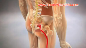 درد سیاتالژی یا سیاتیک؛ از علائم تا بهترین روش‌های درمان و پیشگیری