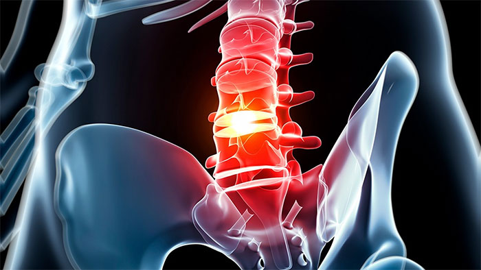 اسپوندیلوز (Spondylosis) یا ساییدگی مهره‌ها
