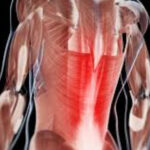 نقش عضله مولتیفیدوس در کمردرد مزمن