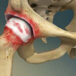 استئوآرتریت (Osteoarthritis): شایع‌ترین بیماری مفصلی