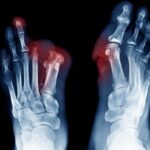 درد اندام فانتوم (Phantom Limb Pain): علل، علائم و جدیدترین روش‌های درمان