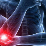 لیزر درمانی مفصل آرنج (Elbow Laser Therapy)؛ درمان غیرجراحی درد و ساییدگی مفصل