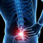 بیماری آراکنوئیدیت؛ علائم، علل و درمان التهاب پرده عنکبوتیه نخاع