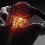 سردرد گردنی (Cervicogenic Headache): علت، علائم و درمان