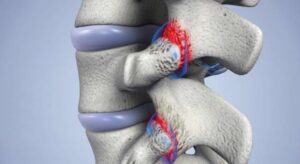 مفاصل فاست چیست و چه نقشی در درد کمر و گردن دارند؟