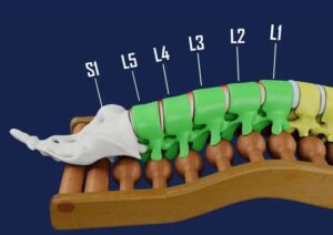 جراحی دیسک L5-S1: راهنمای کامل و جامع برای بیماران و علاقه‌مندان