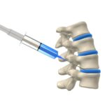 تزریق داخل دیسک (Intradiscal Injection) چیست؟