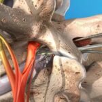 جراحی دیسککتومی دیسک کمر: انواع روش‌ها + مقایسه با RF و PLDD
