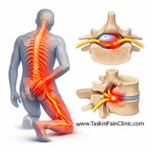 دردهای عصبی و رادیکولار: علل، علائم و روش‌های درمان