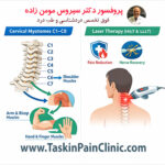میوتوم‌های گردنی و درمان آن با لیزر