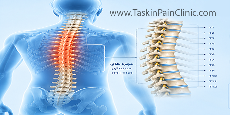 درد مهره‌های سینه‌ای چیست؟ علائم، علل و روش‌های درمان